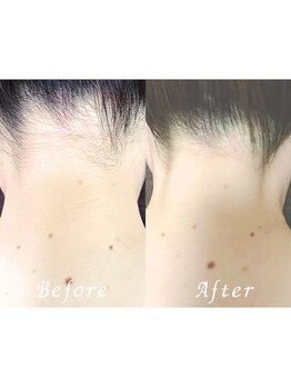 ララリア(LaLaLia)/うなじ脱毛