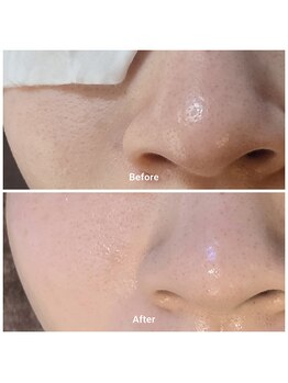 常若(tokowaka)/セラピール/ビフォーアフター