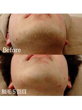 イズム(ism)/脱毛◆1回目 ⇒ 5回目◆