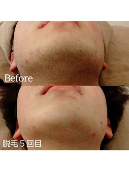 イズム(ism)/脱毛◆1回目 ⇒ 5回目◆