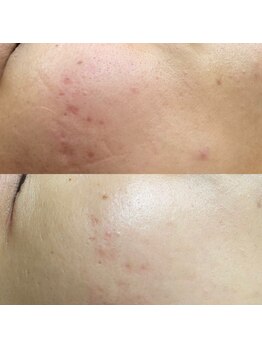 エムズビューティー(M’s Beauty)/ハーブピーリング1回目のお客様