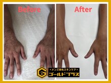 ゴールドプラス 新倉敷店(GOLD PLUS)/腕WAX脱毛ビフォーアフター