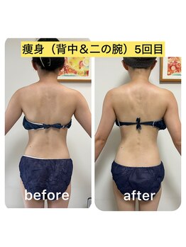 ルクール(Le Couer)/２０代痩身５回の効果