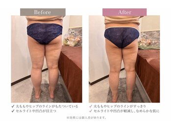 ビューティフルミー(Beautiful Me)の写真/全身のむくみスッキリ!憧れの美脚へ導く痩身エステ☆無理なく気持ち良いダイエットを♪