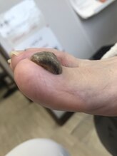 足のケア アンド 巻き爪 エムズ 白金通り店(M's)/肥厚爪