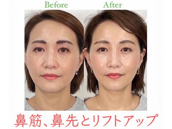 ラプリ 福岡博多店(Raplit)/隆鼻+輪郭・小顔矯正 美鼻/小顔