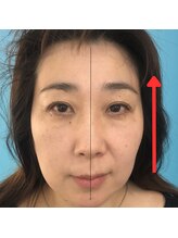 ネクスフィット(Nexfit)/小顔矯正フェイスリフトの効果