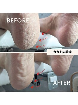 リットフット(LitFoot)/カカトの乾燥