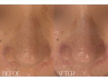 マグノリア(Magnolia)/毛穴洗浄×ソニック＊黒ずみに