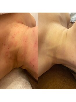 ヴィアス(Vias)/シミケアコース