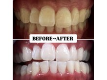 ホワイトニングサロン 宝塚/Before&After美白ホワイトニング