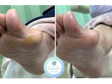 リゼラアンドコー たまプラーザ店/フットキュアコース