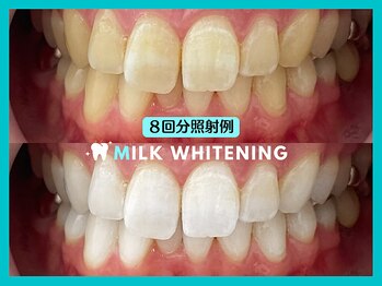 ミルクホワイトニング 久留米店(Milkホワイトニング)/施術例