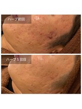 ビビ(VIVI)/男性にも人気のハーブピーリング