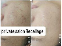 リセラージュ(Recellage)/潤艶フェイスワックス/ニキビ◎