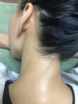 ビーチ(Beach)/WAX脱毛～うなじ～