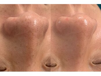 リメイククリニカルビューティー(Remake clinical beauty)/【施術症例】リメイク毛穴洗浄