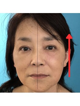 ネクスフィット(Nexfit)/小顔矯正フェイスリフトの効果