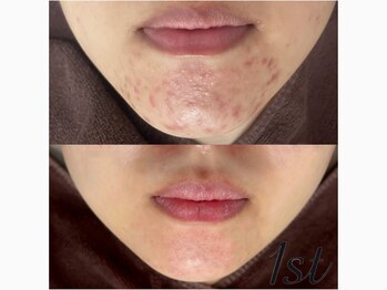 ファースト(1st)/