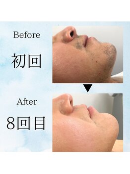 ナユタ(Nayuta)/お悩み撃退！ツルツルお肌！