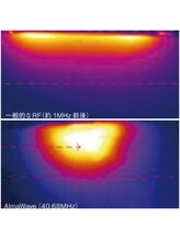 ハッピーハンド(HAPPY HAND)/サーモシェイプOpusのRF