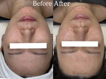 【肌質改善】最新韓国美容を京都で受けれます