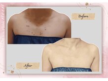 ヌーン(noon)/痩身しながらデコルテも綺麗に