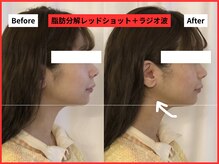 ラ セラフィータ 中目黒/レッドショット＋ラジオ波