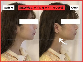 ラ セラフィータ 中目黒/レッドショット＋ラジオ波