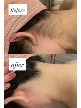 敏感肌専科・眠れる美肌脱毛Amitie札幌琴似店〈顔脱毛/毛穴洗浄/フェイシャル〉/【施術症例】うなじ脱毛