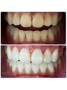 ラブホワイトニング 下北沢店(LOVEホワイトニング)/効果抜群