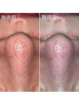 クレアーレ(creare)/ハイドロスキン・施術結果 2