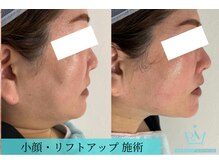 リメイクビューティークリニック(REMAKE BEAUTY CLINIC)/たるみ・小顔にアプローチ