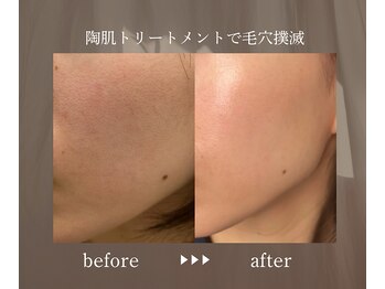 エメ(eme)/広がる毛穴を毛穴レスに