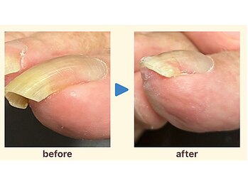 かがわ接骨院 高松伏石院/巻き爪でお悩みの方へ！