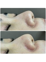 ニナル(ninal)/毛穴洗浄+まつげパーマ