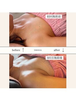 エミニナル(EMININAL)/【バストケア】ビフォーアフター