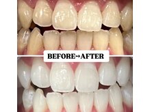 ホワイトニングサロン 宝塚/Before&After美白ホワイトニング