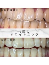 ホワイトスマイル(White Smile)/【ビフォーアフター】2回施術