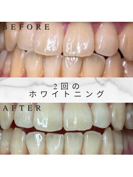 ホワイトスマイル(White Smile)/【ビフォーアフター】2回施術