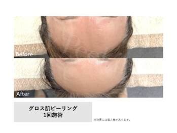 モイ(Moi’e)/シワ・小ジワ・たるみ