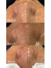 ベベ(bebe)/油分多めのお客様