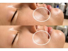 エステ リラクゼーションサロン(more)の雰囲気(徐々に現れる夏の肌疲れに◎ハーブピーリングで毛穴・小じわケア)