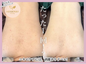 ハーバリー ハーブピーリング 大阪梅田店(HERBERRYハーブピーリング)/梅田ハーブピーリングHERBERRY