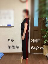 たか施術院/肩こり 背中の痛み 初回～２回目