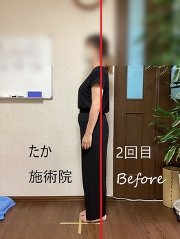 たか施術院/肩こり 背中の痛み 初回～２回目