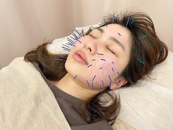 こじま 富雄団地接骨院/美容鍼