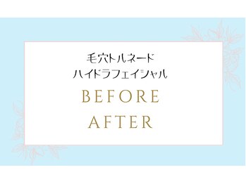 ミラー(MIRAOR)/毛穴ハイドラ洗浄フェイシャル