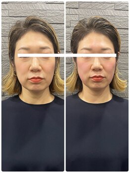 長寿鍼灸院 長寿整骨院/ハリネズミ女優美容鍼効果★