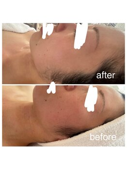 アリュール(Allule)/赤み、ニキビ◇敏感肌コース